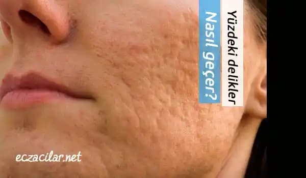 Yüzdeki Kepek Nasıl Geçer Doğru Çözüm Yöntemleri ve İpuçları