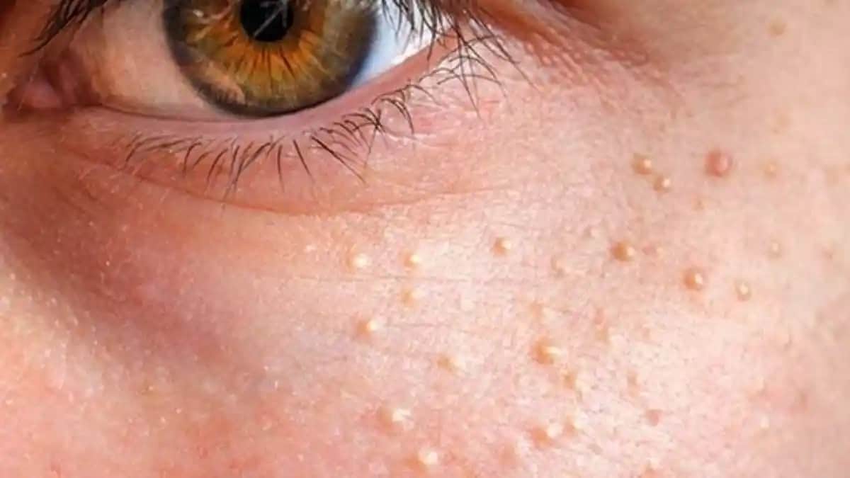 Yüzdeki Komedonlara Karşı Etkili Yöntemler ve Doğal Bakım İpuçları