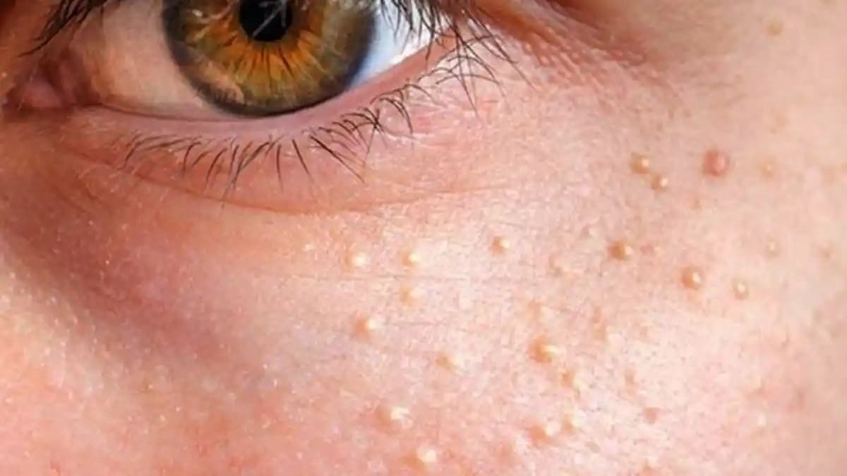 Yüzdeki Komedonlara Karşı Etkili Yöntemler ve Doğal Bakım İpuçları