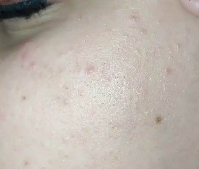 Yüzdeki Küçük Sivilcelerin Nedenleri ve Etkili Çözüm Yolları Hakkında Kapsamlı Bilgi