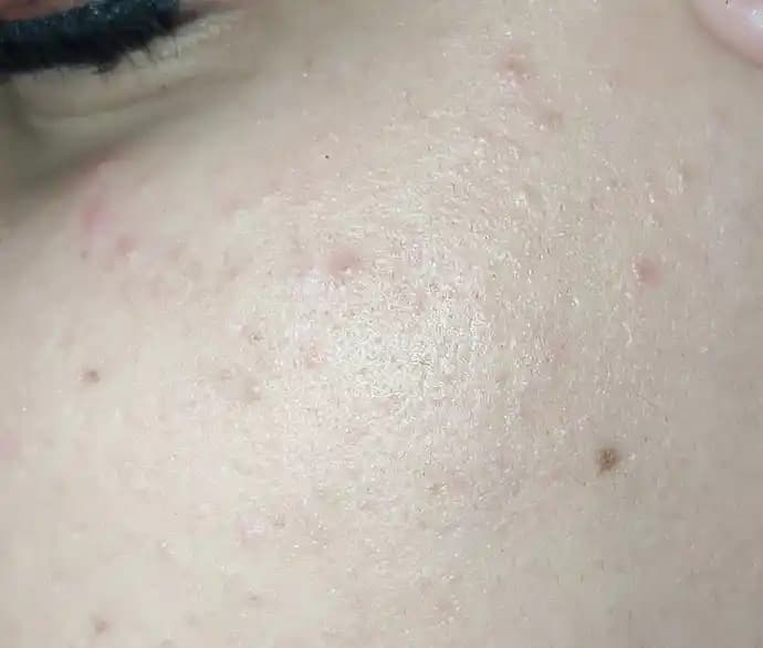 Yüzdeki Küçük Sivilcelerin Nedenleri ve Etkili Çözüm Yolları Hakkında Kapsamlı Bilgi