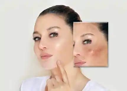 Yüzdeki Lekeleri Gidermenin Etkili Yolları ve Cilt Sağlığı İçin Profesyonel Tavsiyeler