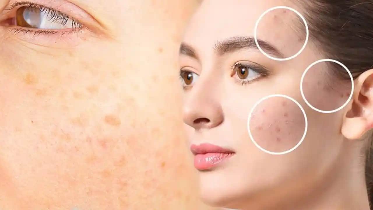 Yüzdeki Lekelerin Nedenleri ve Etkili Tedavi Yöntemleri Bilimsel Rehber