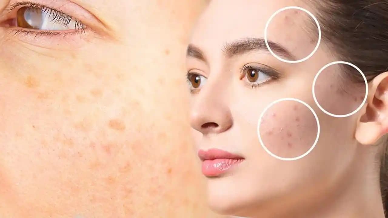Yüzdeki Lekelerin Nedenleri ve Etkili Tedavi Yöntemleri Bilimsel Rehber