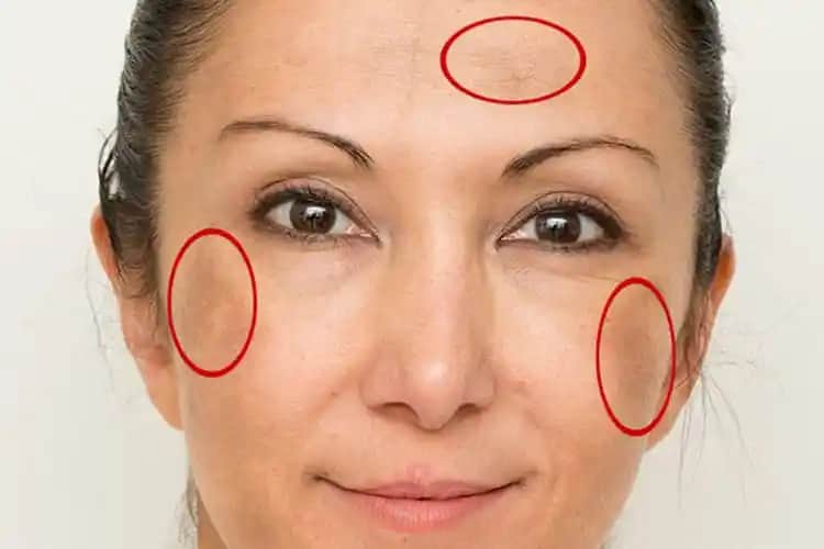 Yüzdeki Likelere Karşı En Etkili Sabunlar ve Cilt Temizliği İpuçları