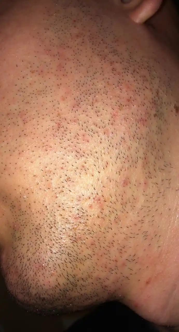 Yüzdeki Minik Sivilceler: Nedenleri, Çözüm Yolları ve Günlük Bakım İpuçları