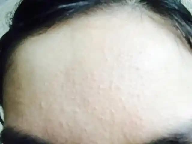 Yüzdeki Pütürlü Sivilceleri Geçirmek İçin Etkili Yöntemler ve Cilt Bakım İpuçları