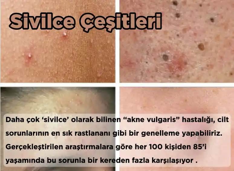 Yüzdeki Sivilce Çeşitleri ve Tedavi Yöntemleri Hakkında Kapsamlı Bilgi