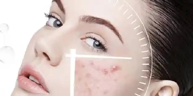 Yüzdeki Sivilce Lekeleri Nasıl Geçer Evde Doğal ve Etkili Yöntemler