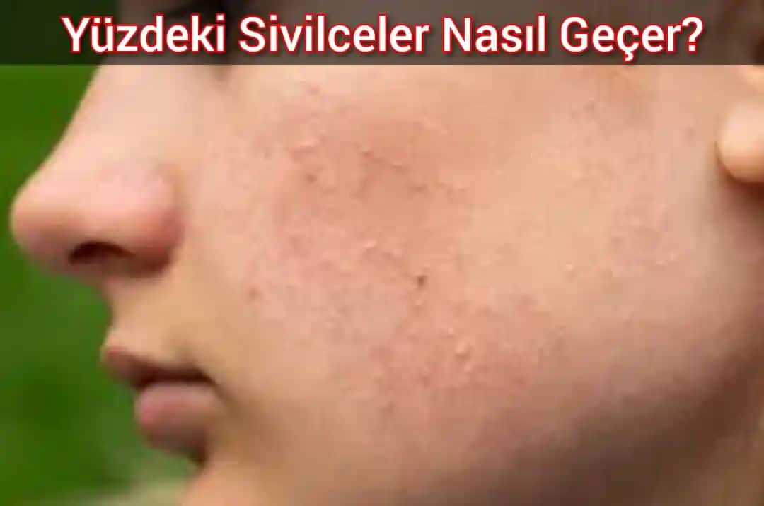 Yüzdeki Sivilce Yaralarının Nedenleri ve Etkili Tedavi Yöntemleri