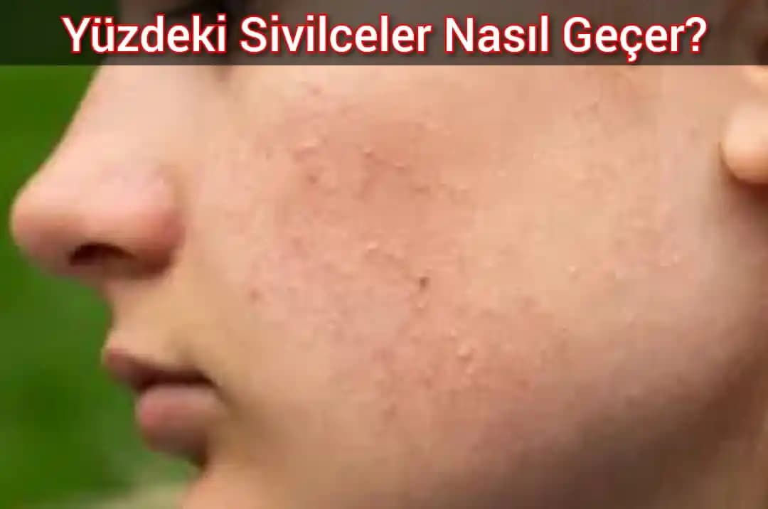 Yüzdeki Sivilce Yaralarının Nedenleri ve Etkili Tedavi Yöntemleri