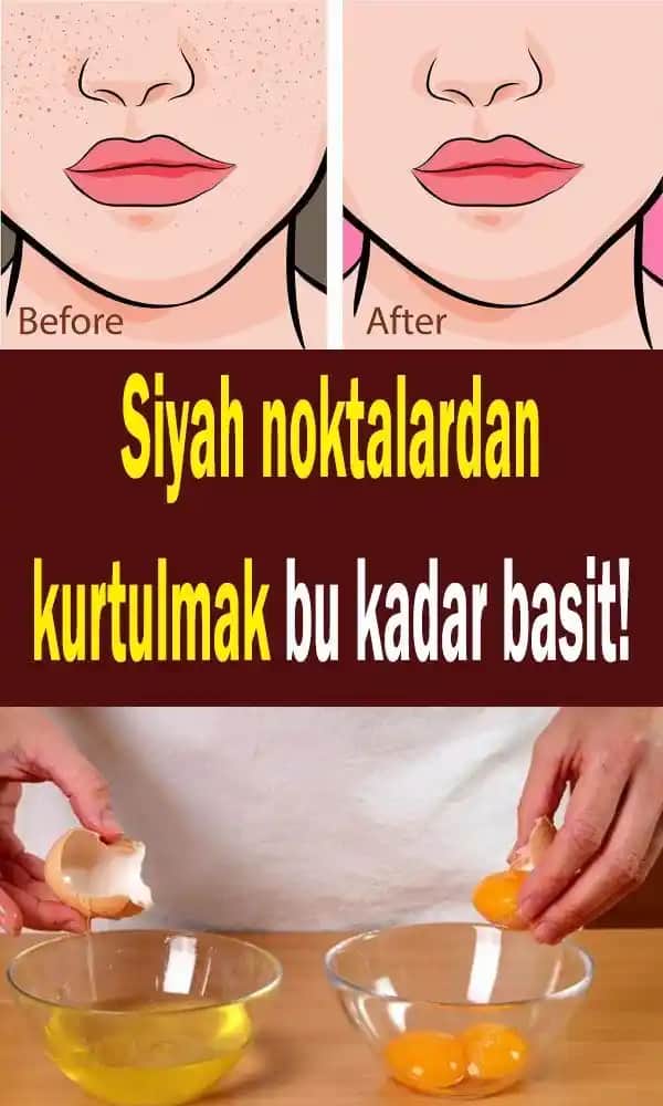 Yüzdeki Siyah Noktaları Doğal ve Etkili Yöntemlerle Giderme Rehberi