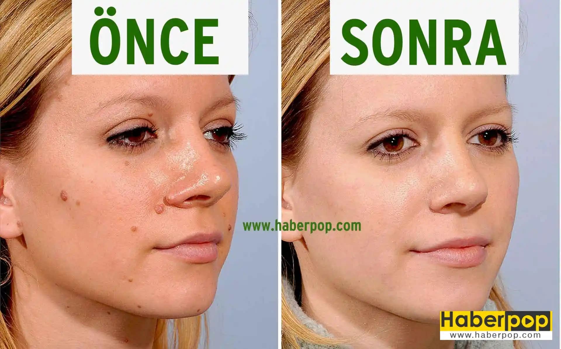 Yüzdeki Soyulmayı Önleme ve Giderme Yöntemleri Cilt Bakımında Etkili Stratejiler