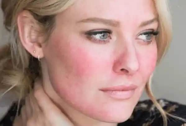 Yüzdeki Tahriş Kaç Günde Geçer ve Hızlı İyileşme Yöntemleri