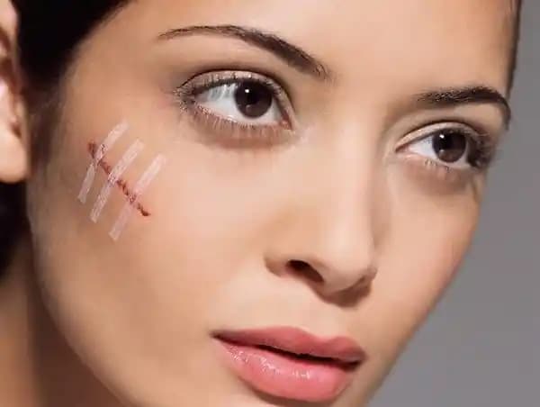 Yüzdeki Yara İzleri İçin Etkili Yöntemler ve Doğal Çözümler