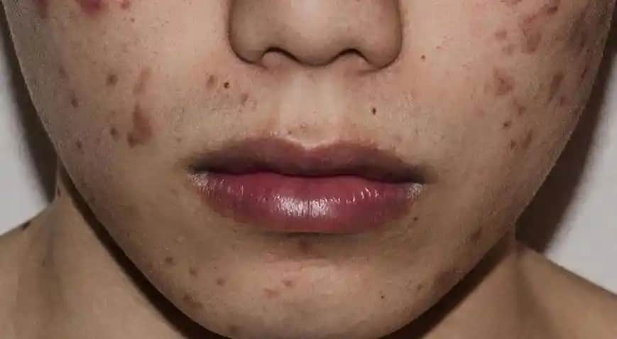 Yüzdeki Yara ve İzlerin İyileşme Süresi ve Bakım Yöntemleri Hakkında Kapsamlı Bilgi