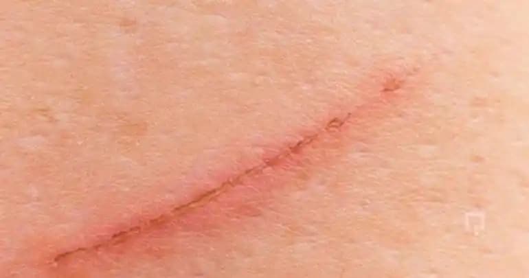 Yüzeysel Tırnak İzi Nedir ve Nasıl Giderilir: Etkili Bakım Yöntemleri ve İpuçları