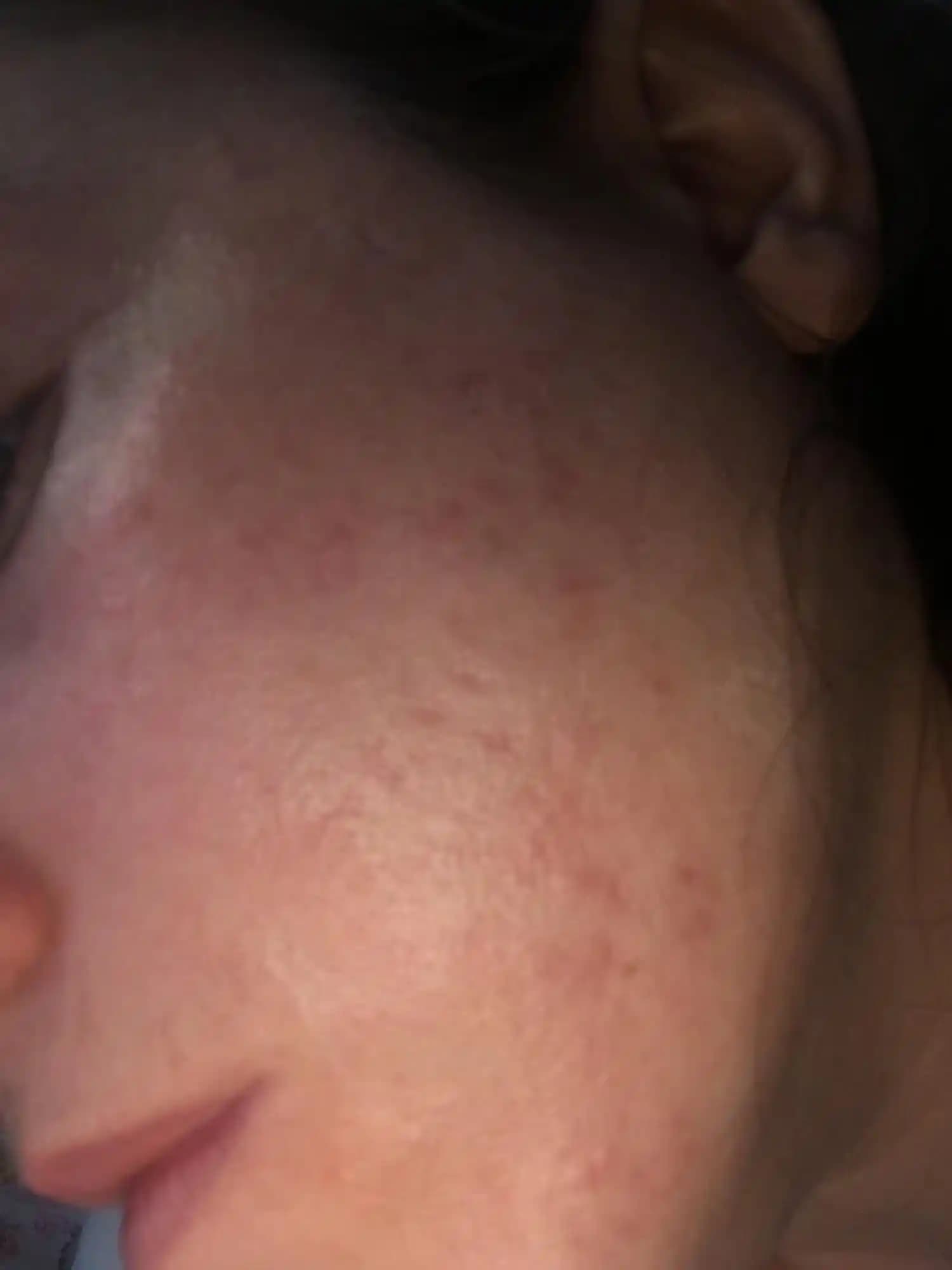 Yüzünüzde Kırmızı Nokta Çıkması Nedenleri ve Etkili Çözüm Yöntemleri