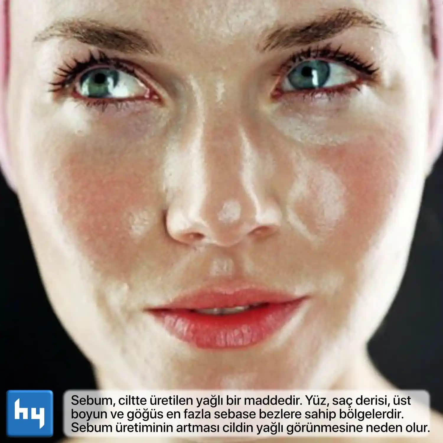 Aşırı Yağlı Yüz Sorunu: Nedenleri Belirtileri ve Etkili Çözüm Yöntemleri