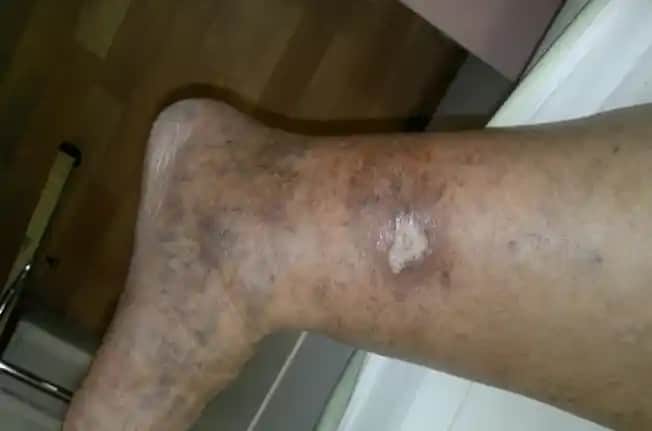 Ayak Lekeleri Nedenleri, Türleri ve Etkili Tedavi Yöntemleri Hakkında Kapsamlı Bilgi