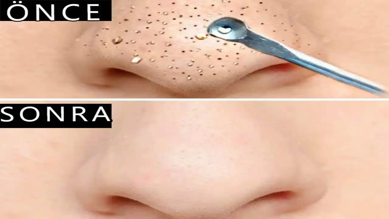 Burun Kenarı Siyah Nokta Problemi ve Çözüm Yolları Cilt Bakımında Etkili Yöntemler