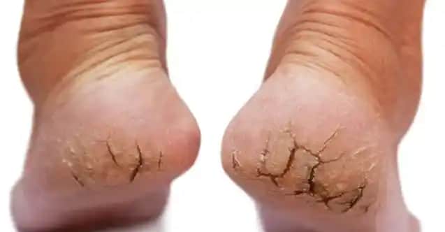 Çatlak Ayaklara Karşı Etkili Doğal Çözüm Yöntemleri ve Bakım Tavsiyeleri