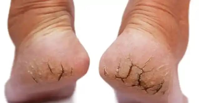 Çatlak Ayaklara Karşı Etkili Doğal Çözüm Yöntemleri ve Bakım Tavsiyeleri