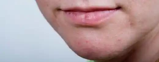 Çenede Kızarıklık ve Pullanma Nedenleri, Belirtileri ve Etkili Çözüm Yolları