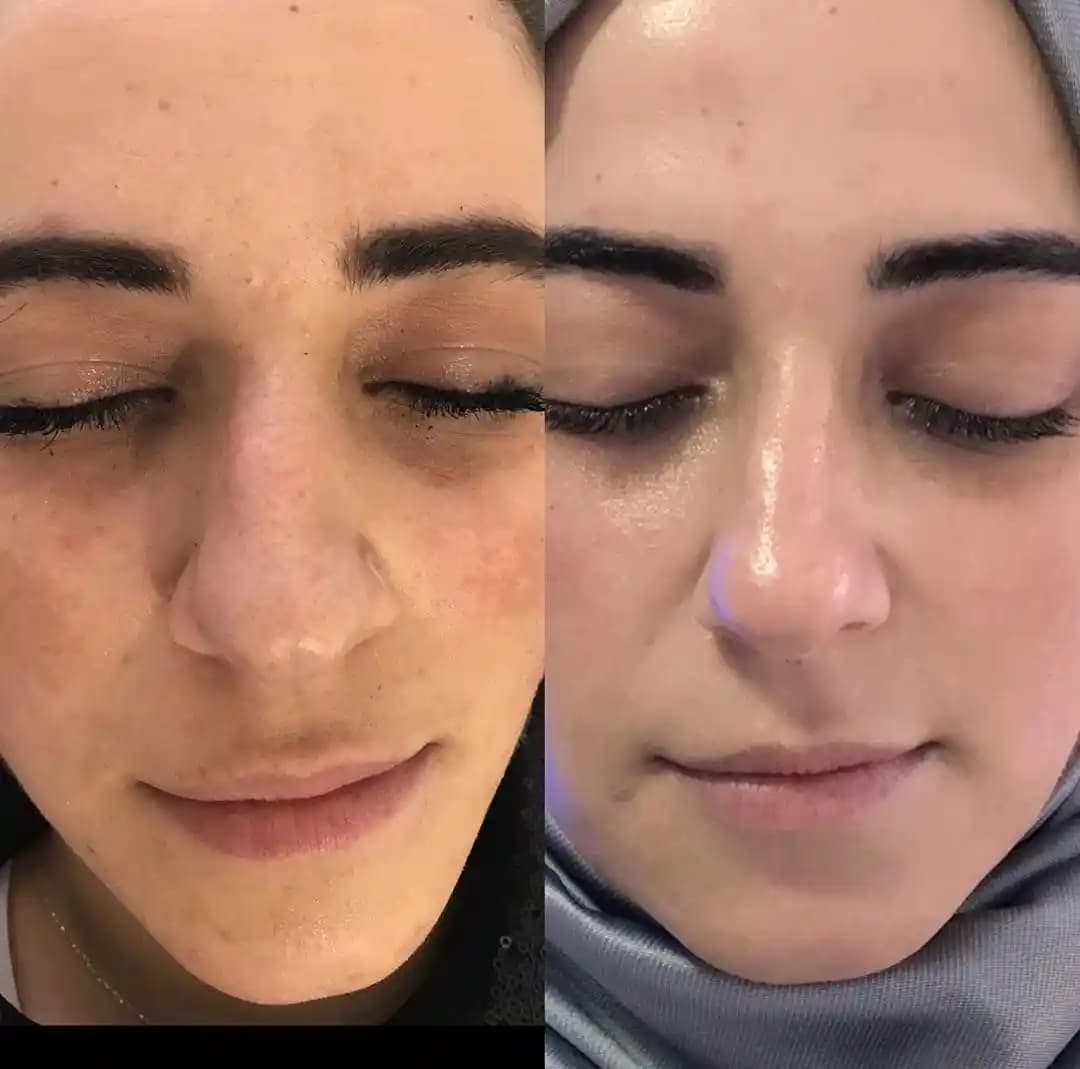 Cilt Gözeneklerini Sıkılaştırma Yöntemleri ve Etkili Tedavi Seçenekleri