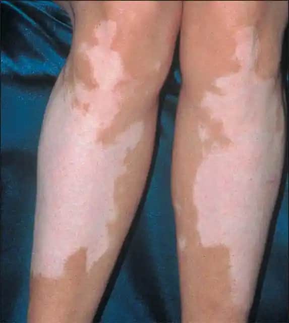 Ciltte Beyaz Lekeler: Nedenleri, Tedavi Seçenekleri ve Koruyucu İpuçları