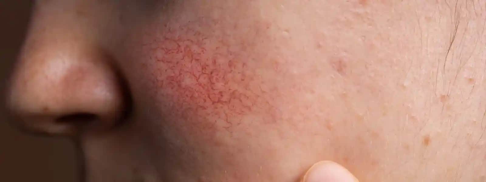 Ciltte Tahriş Belirtileri ve Doğru Bakım Yöntemleri Hakkında Kapsamlı Rehber