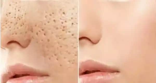 Ciltteki Gözenekleri Temizleme Yöntemleri ve Bakım İpuçları Rehberi