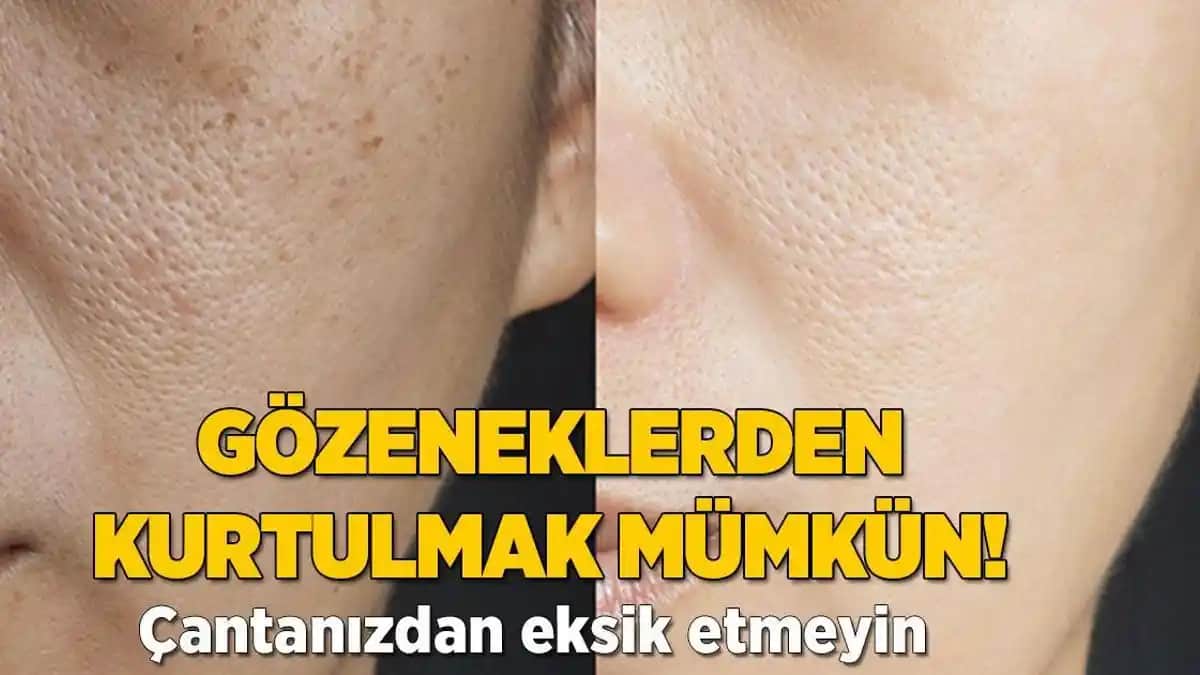 Ciltteki Gözeneklerin Nedenleri ve Kontrol Altına Alınma Yöntemleri