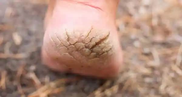 Derin Topuk Çatlaklarının Nedenleri, Tedavi Yöntemleri ve Koruyucu İpuçları