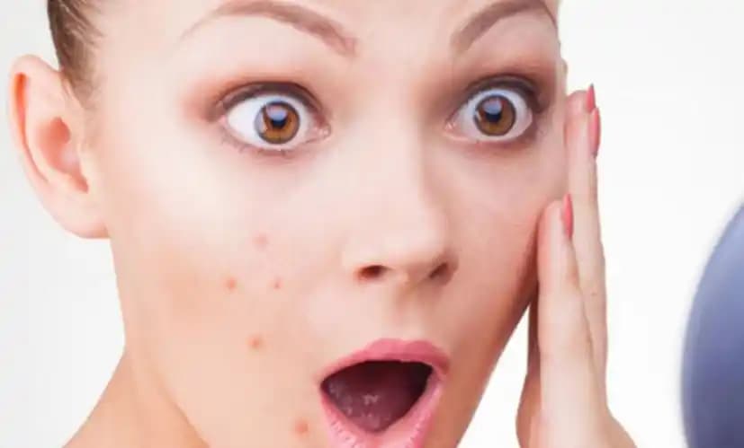 Doktor Onaylı Sivilce Maskeleri ile Sağlıklı ve Parlak Cilt İçin En Etkili Çözümler