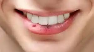 Dudak Çevresi Siyah Nokta Problemi: Nedenleri, Tedavi Yöntemleri ve Koruyucu Tavsiyeler