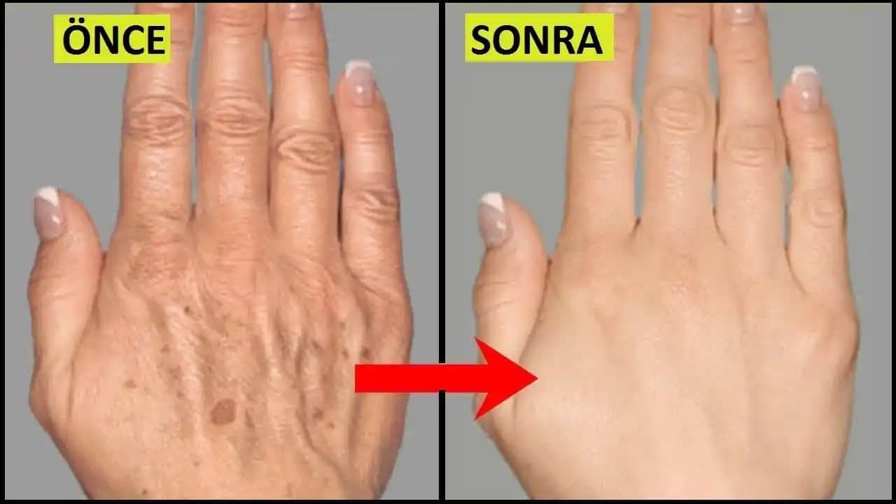 Elde Çıkan Lekeler ve Kozmetik Çözümler: Cilt Sağlığınızı Koruma Yöntemleri