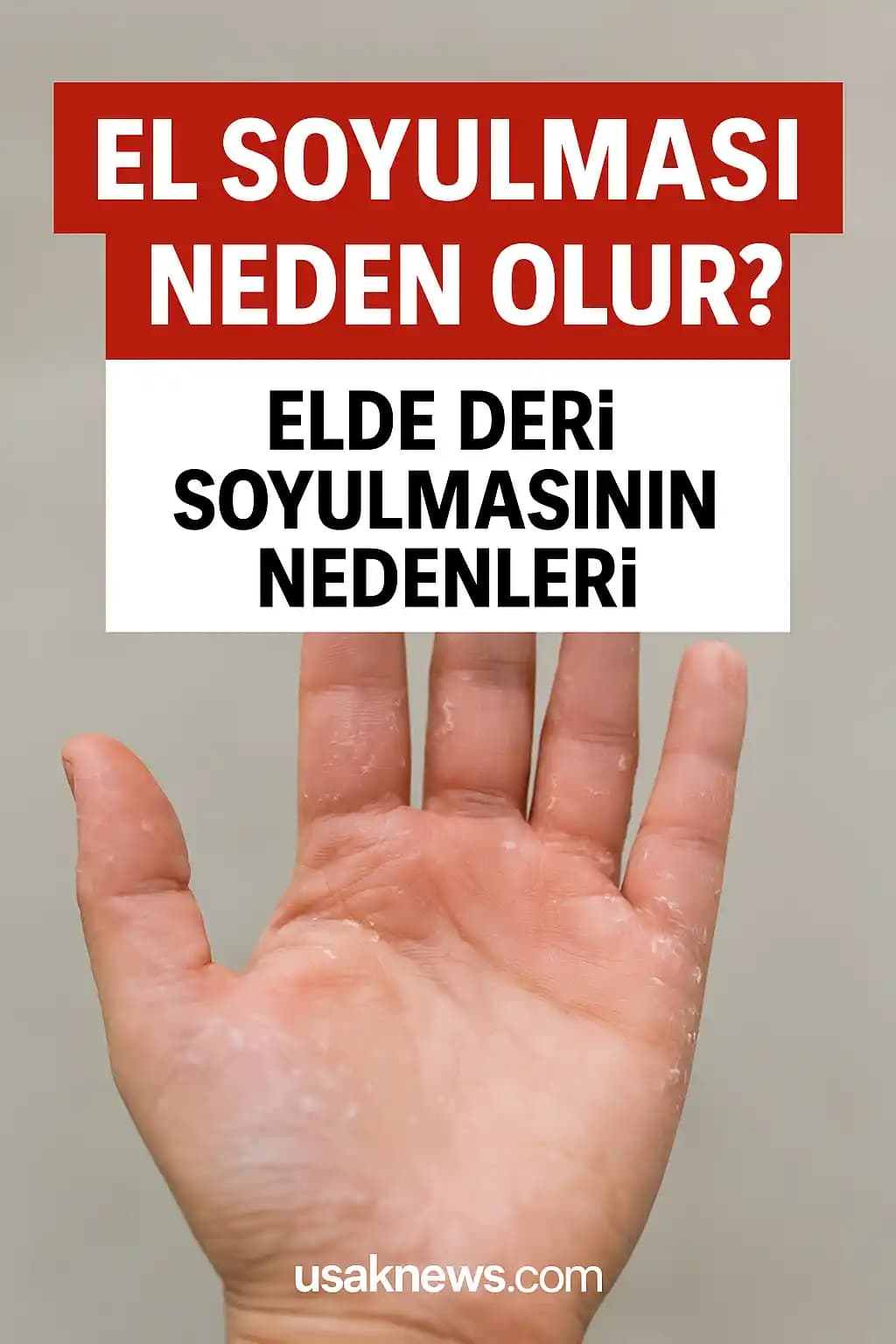 Elde Soyulma Nedenleri ve Etkili Çözüm Yolları Cilt Sağlığını Koruma Rehberi