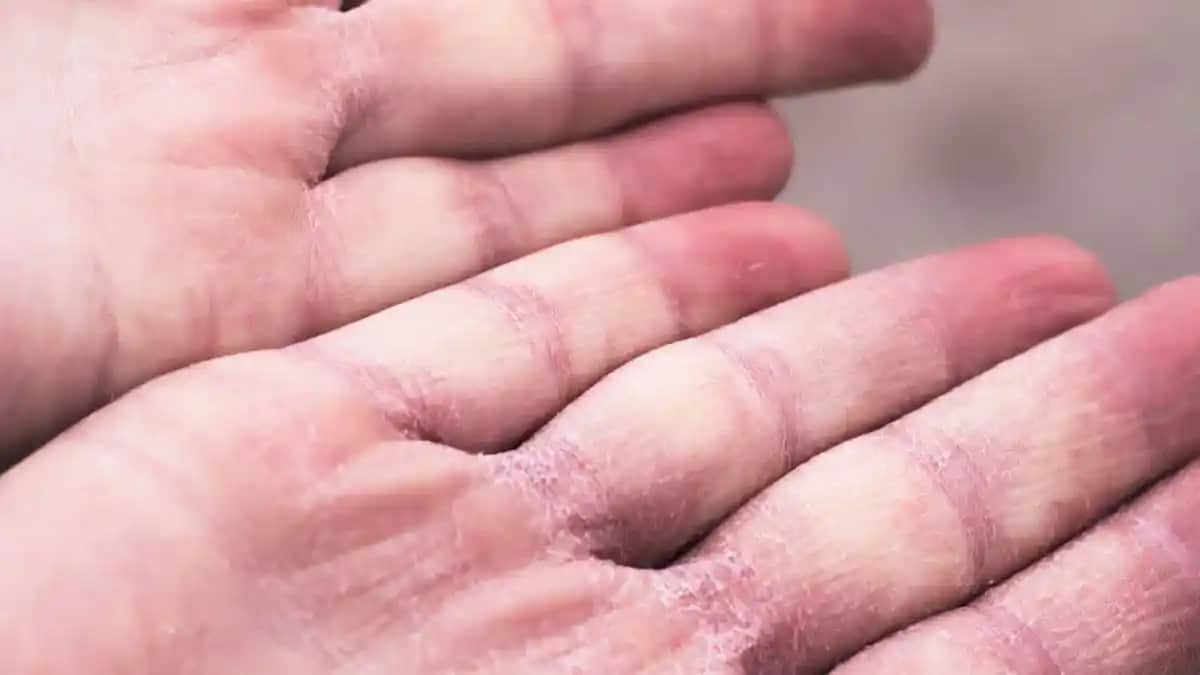 Ellerinizdeki Çatlaklar ve Kurulukla Başa Çıkma Yöntemleri Hakkında Detaylı Bilgiler ve Öneriler