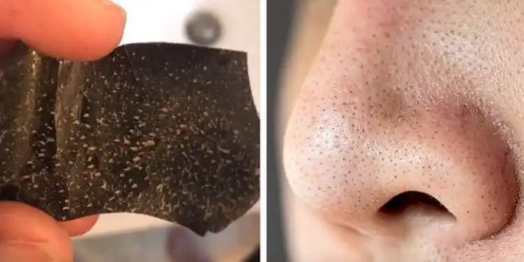 En Büyük Siyah Nokta Problemi ve Cilt Sağlığını Koruma Yöntemleri