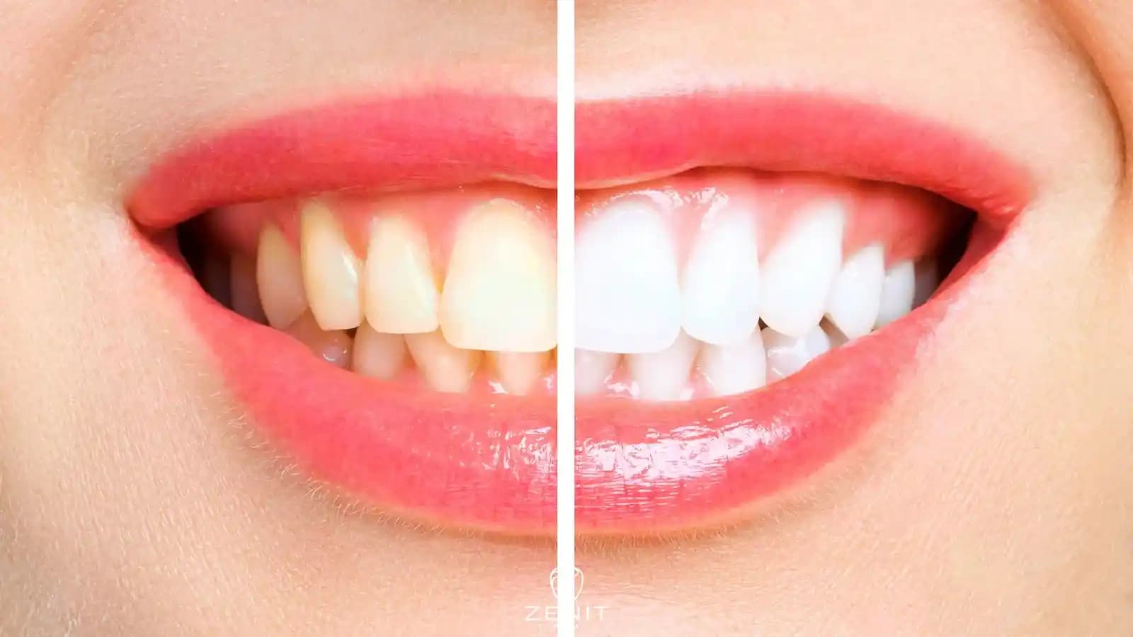 En Etkili Diş Beyazlatma Yöntemleri ve Güvenilir Seçenekler Hakkında Bilgiler