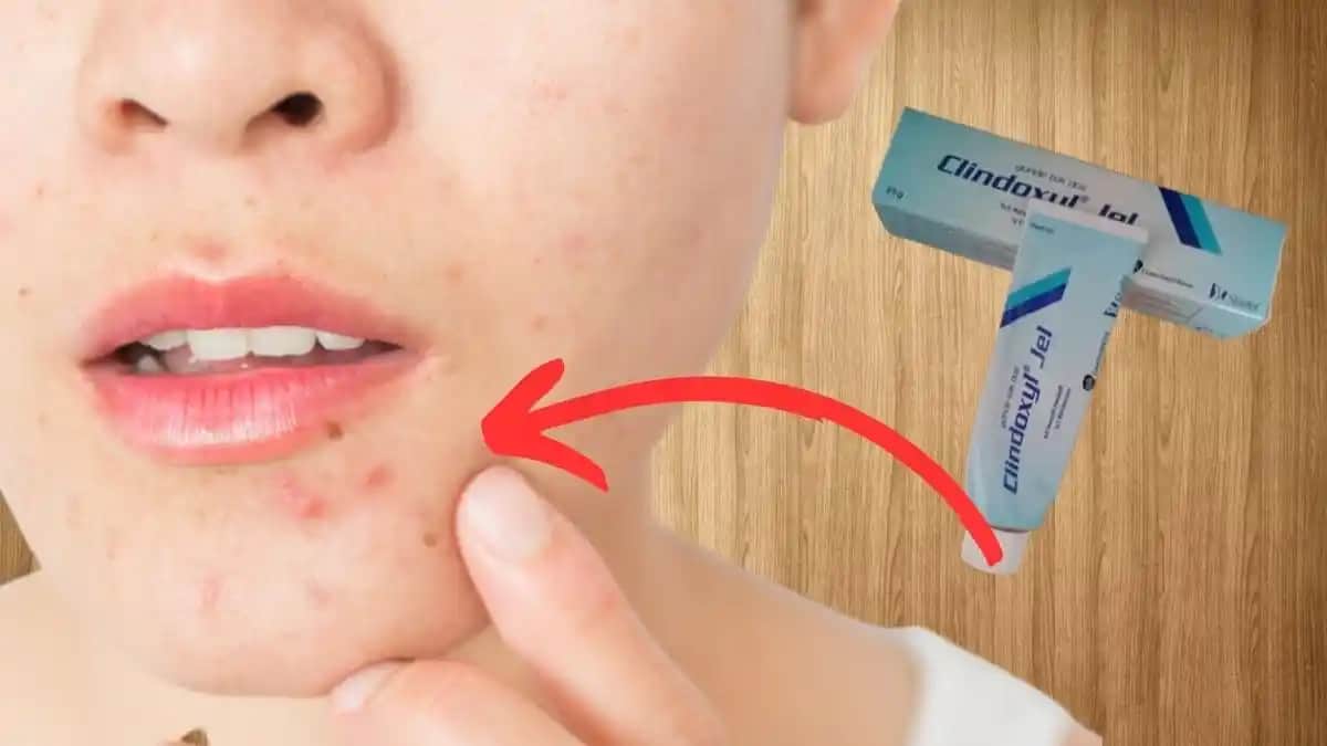 En Etkili Sivilce İlacı ve Doğru Tedavi Yöntemleri Hakkında Bilgiler