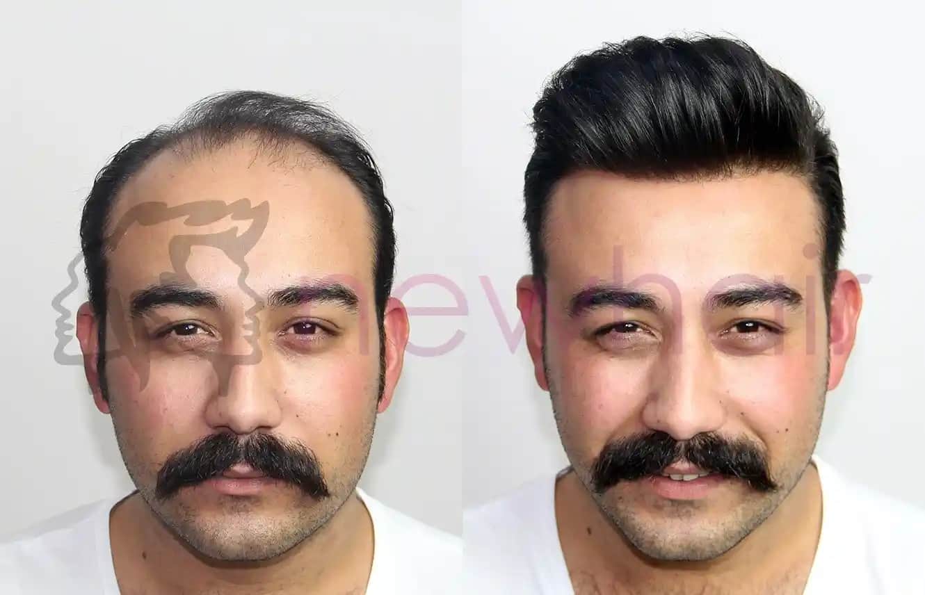 Erkek Protez Saç Uygulamaları: Doğal Görünüm ve Güven Artırıcı Çözümler