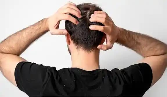 Erkekler İçin Kepek Sorunu Nedenleri ve Etkili Çözüm Yöntemleri Hakkında Detaylı Bilgi
