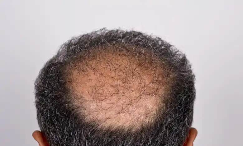 Erkeklerde Saç Dökülmesine Karşı Doğal Yağlar ve Etkili Kullanım Yöntemleri