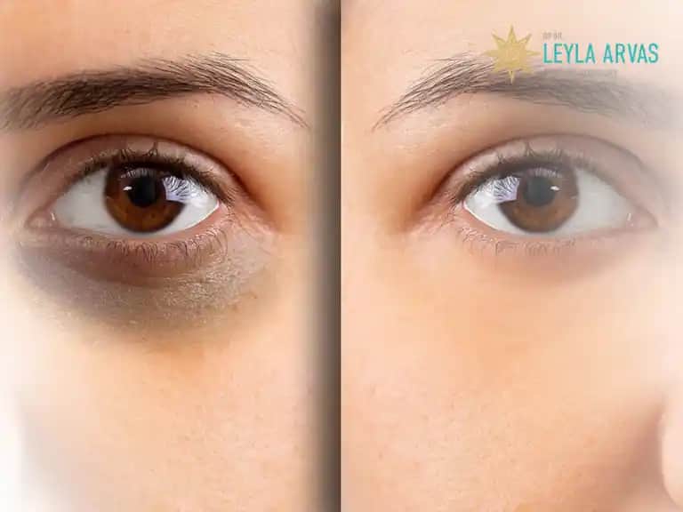 Göz Altı Morluklarına Karşı Etkili Çözümler ve Expigment Ürününün Faydaları