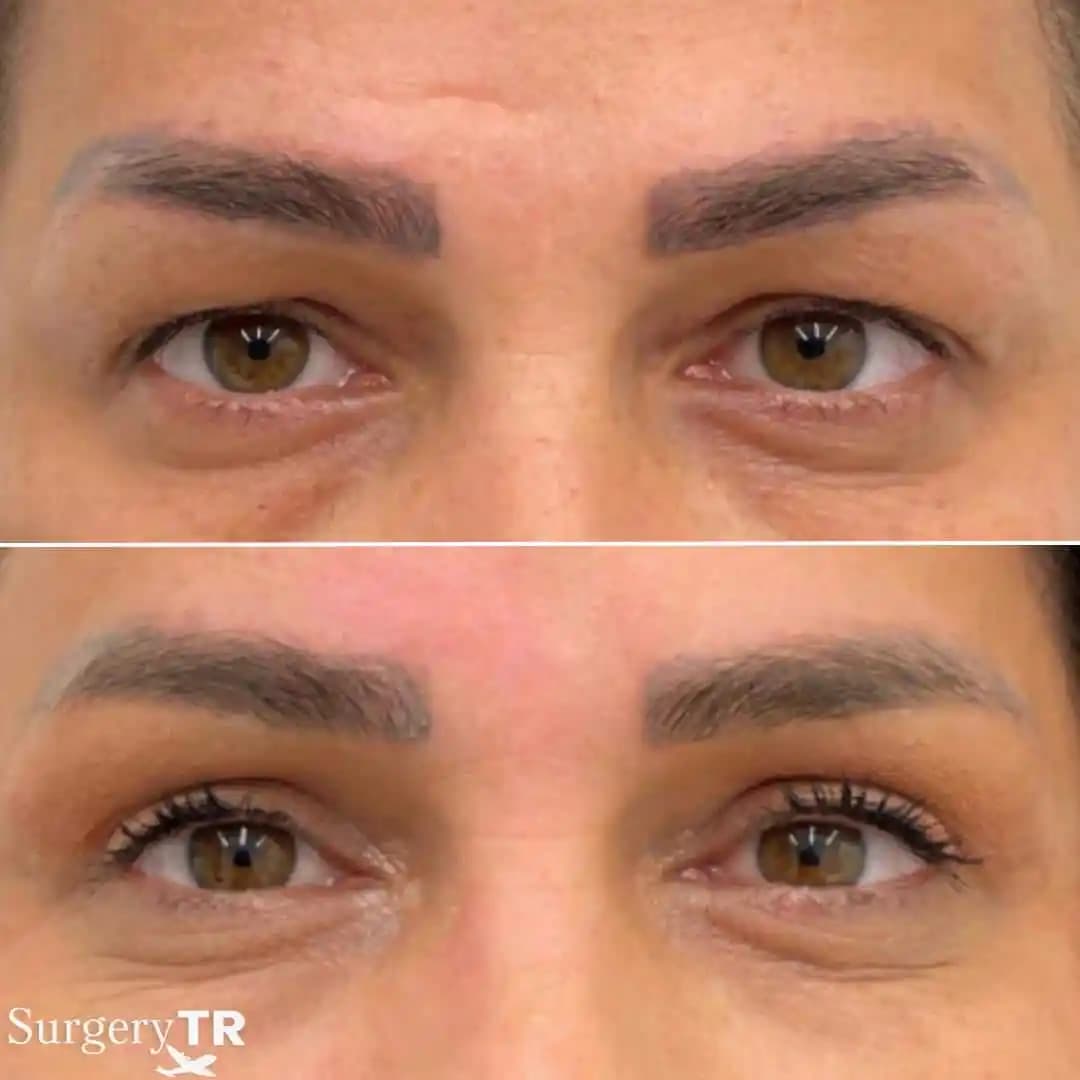 Göz Kapağı Sıkılaştırma Yöntemleri ve Gençlik İçin Yenilikçi Çözümler