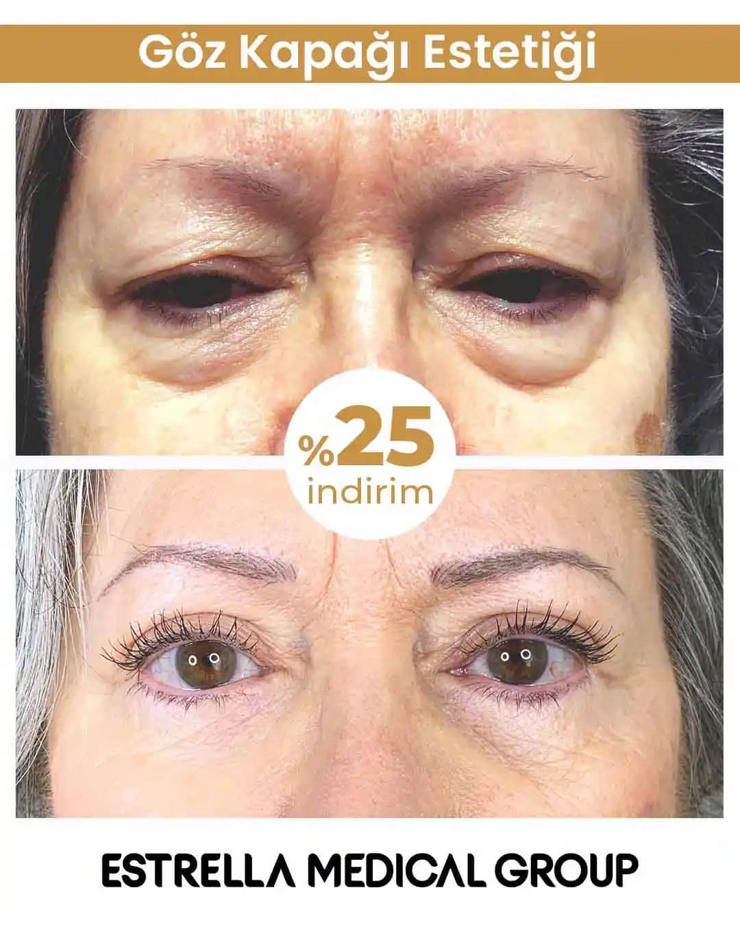 Göz Kapaklarındaki Kırışıklıkların Etkili Bakımı ve Tedavi Yöntemleri