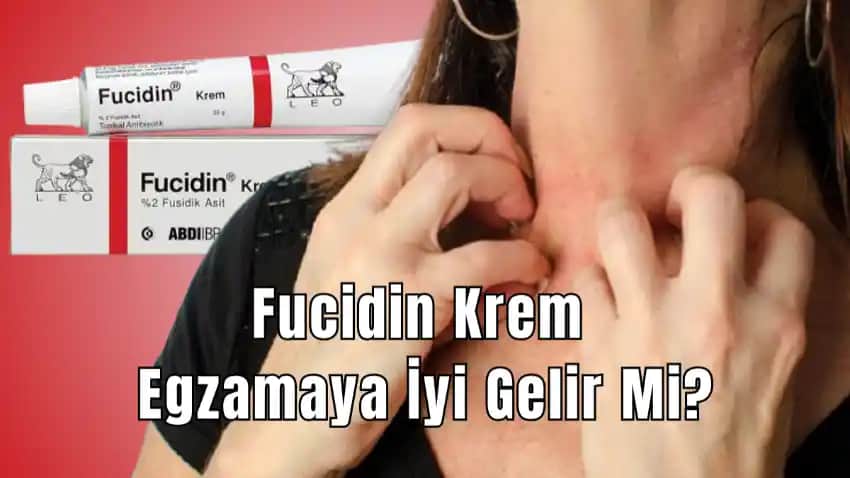 Gözdeki Egzama İçin En Etkili Kremler ve Bakım İpuçları