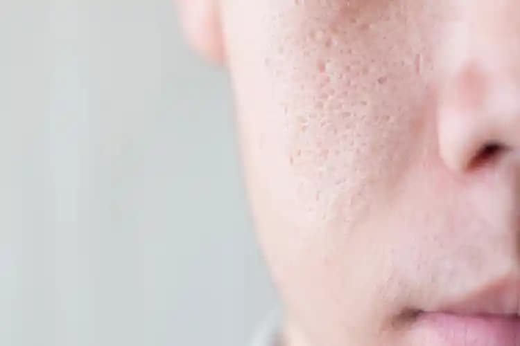 Gözenek Genişlemesi Nedenleri ve Etkili Çözüm Yolları